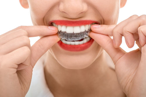 Invisalign